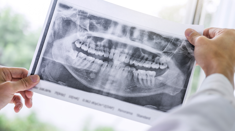 Dental Imaging - Printed X-Ray