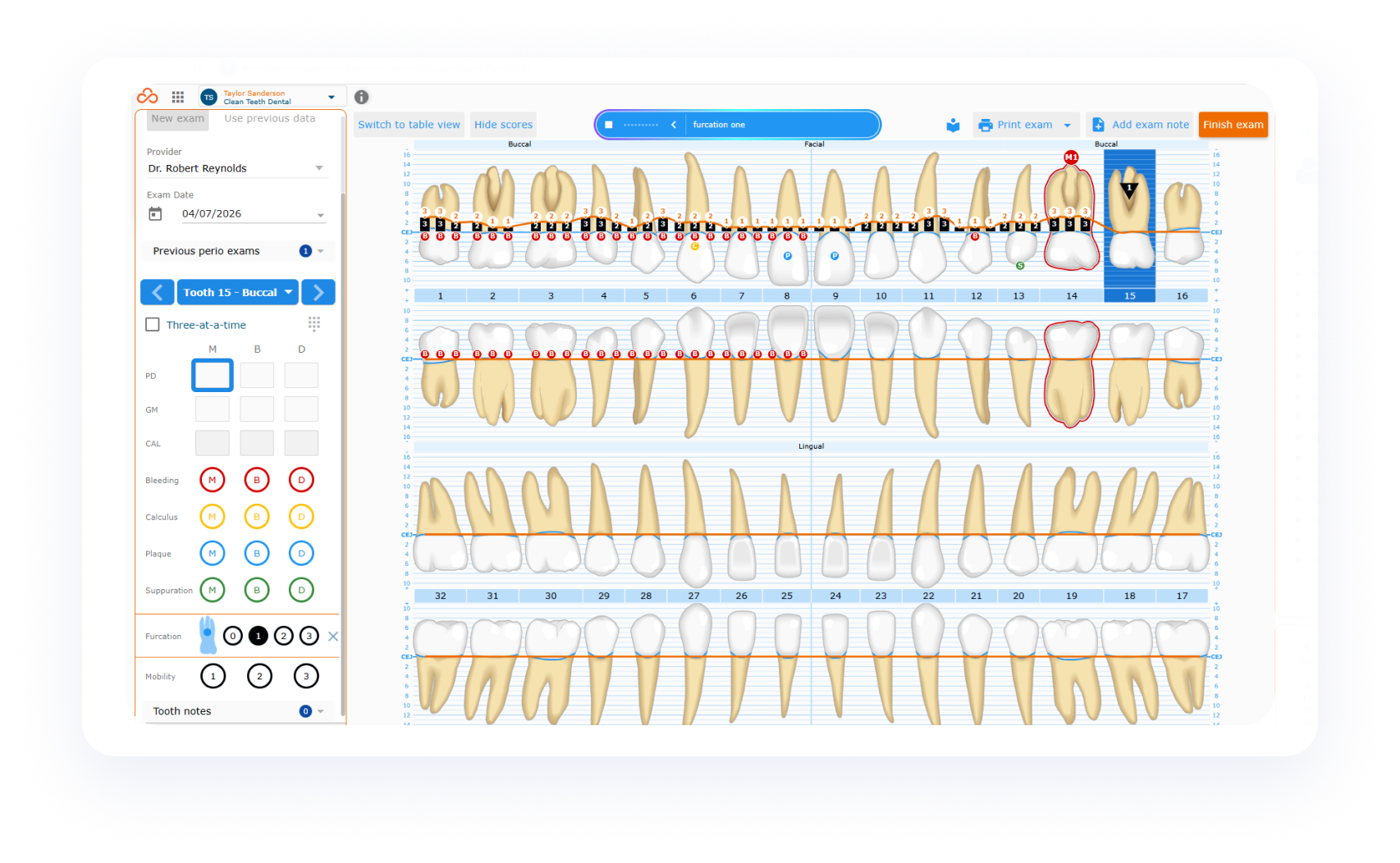 The Curve FLO Care Perio+ interface capturing probe depths and periodontal conditions hands-free via ambient AI voice input during a solo perio exam